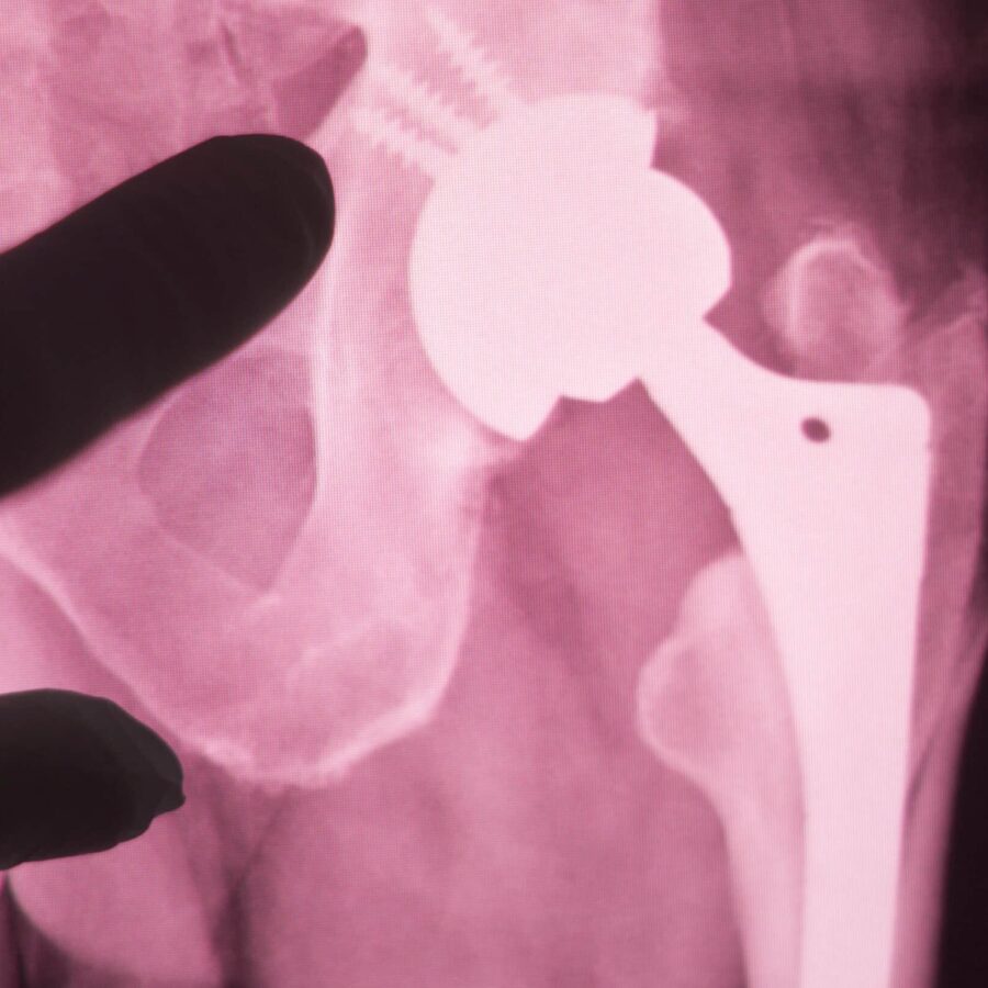 Hip Replacement X-Ray