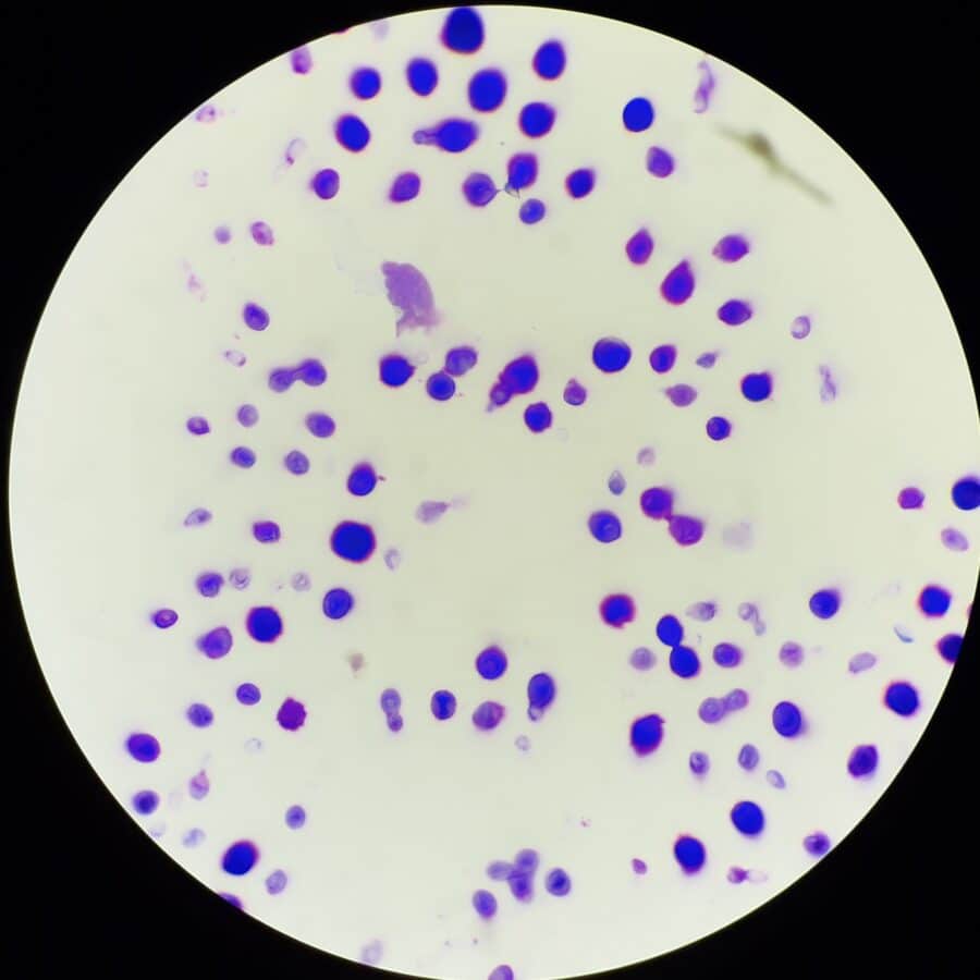 Meningitis Under Microscope